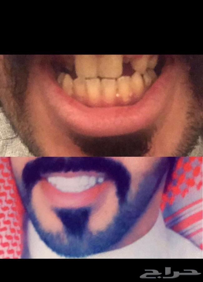 الرياض - ابتسامة الفينير