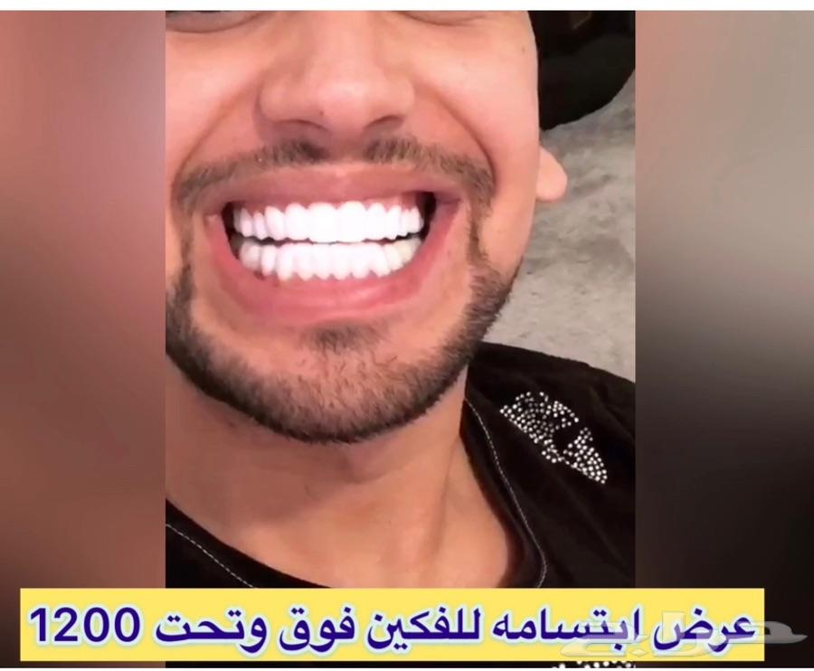 الرياض - ابتسامة الفينير