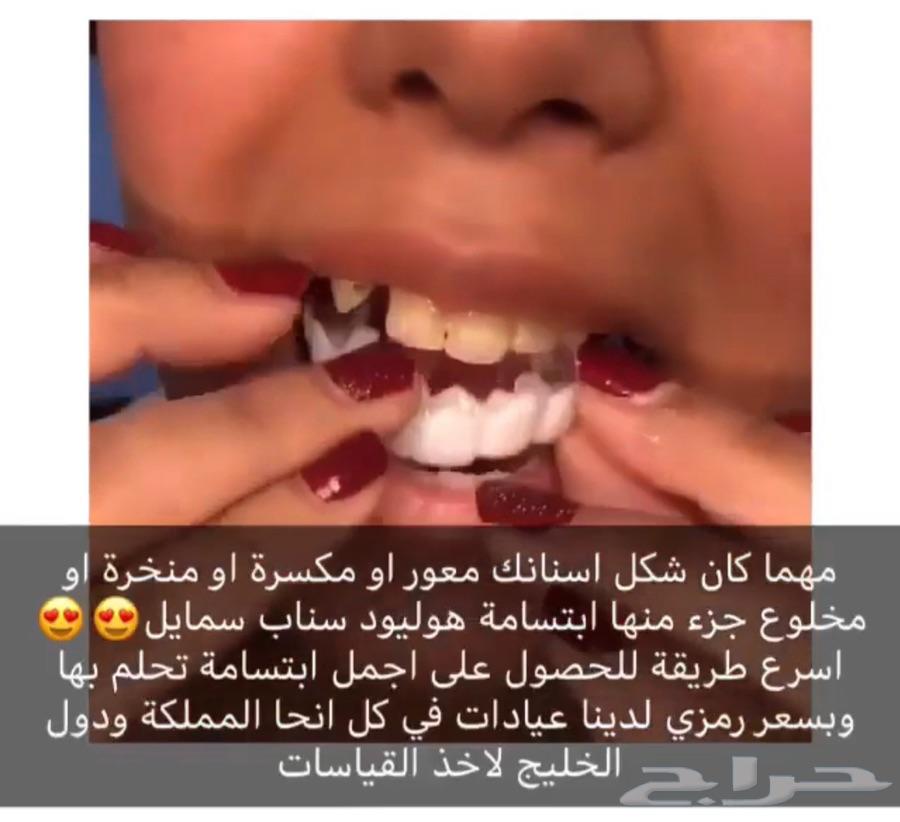 الرياض - ابتسامة الفينير
