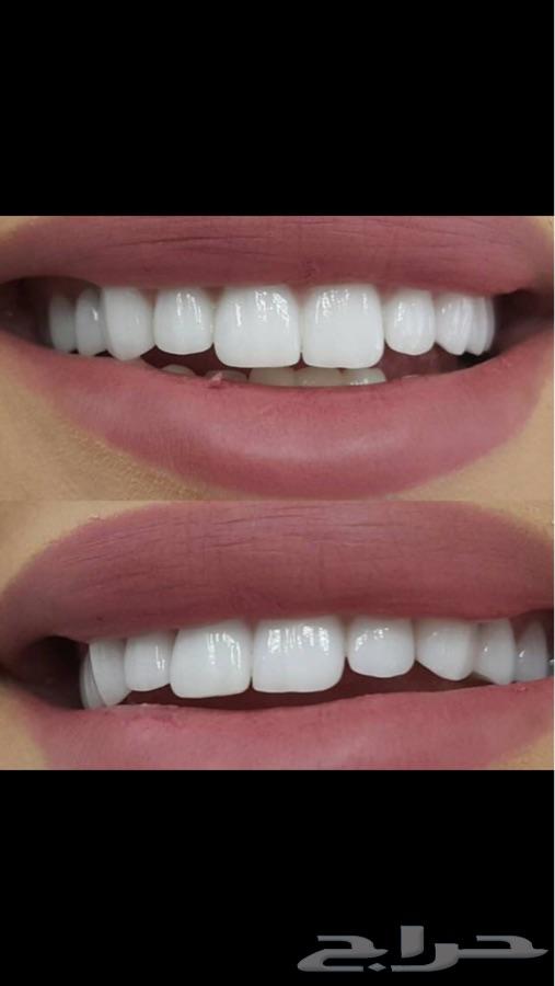 ابتسامه هوليود ابتسامه المشاهير فقط ب850