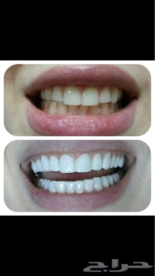 ابتسامه هوليود ابتسامه المشاهير فقط ب850