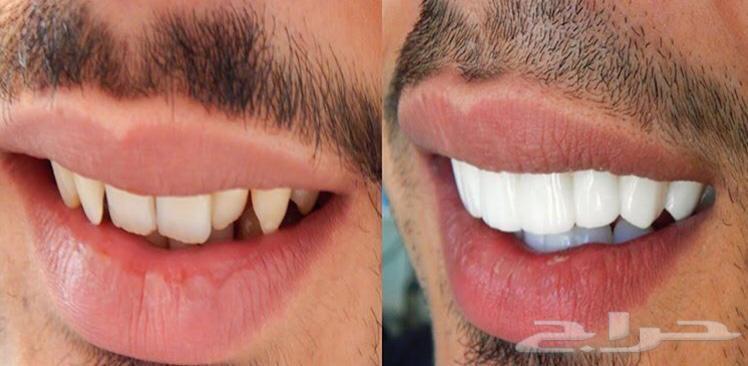 الفينير المتحرك بأسعار مناسبه لجده ومكه