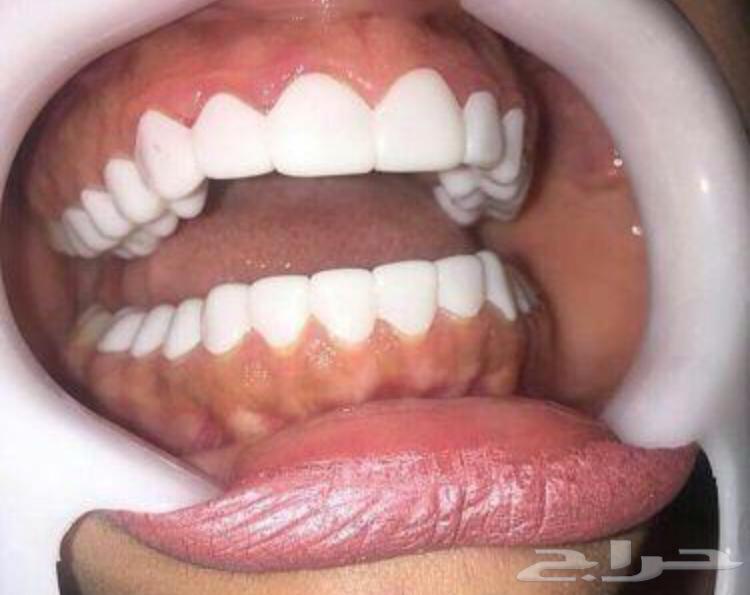 الفينير المتحرك بأسعار مناسبه لجده ومكه