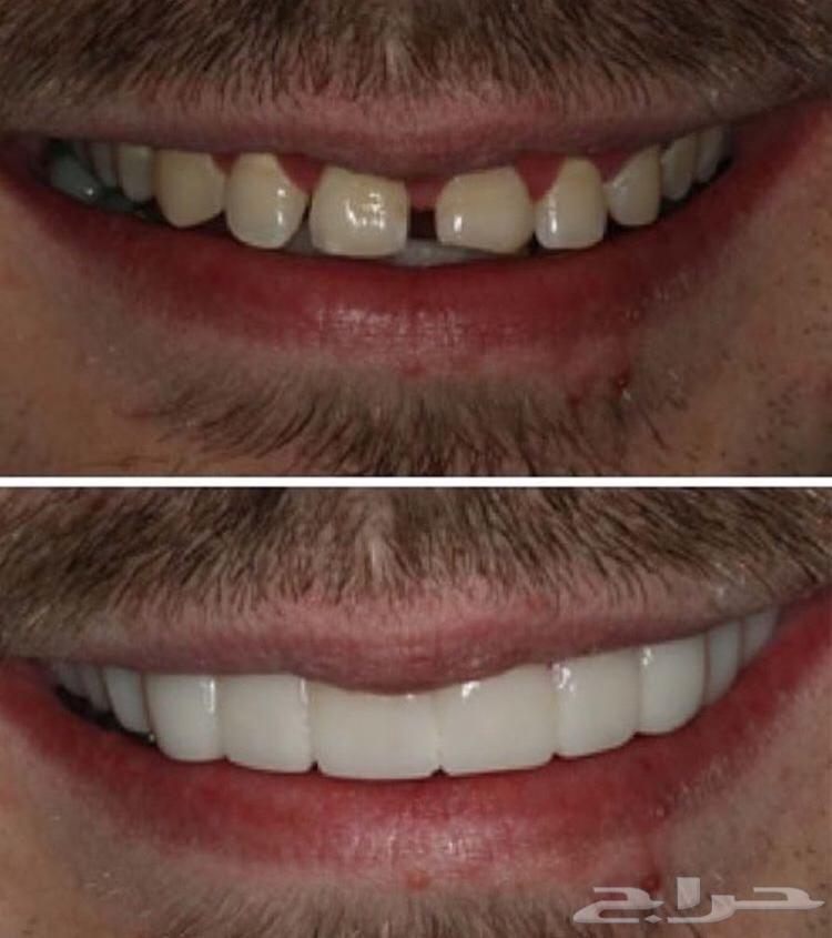 الفينير المتحرك بأسعار مناسبه لجده ومكه