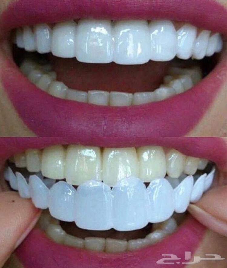 الفينير المتحرك بأسعار مناسبه لجده ومكه