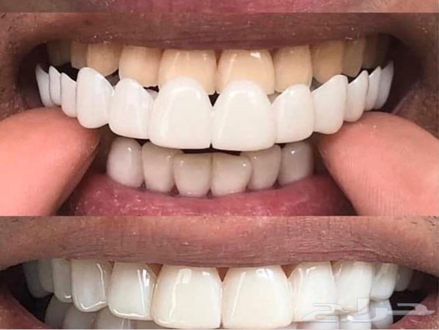 ابتسامه هوليود متحركه 1300