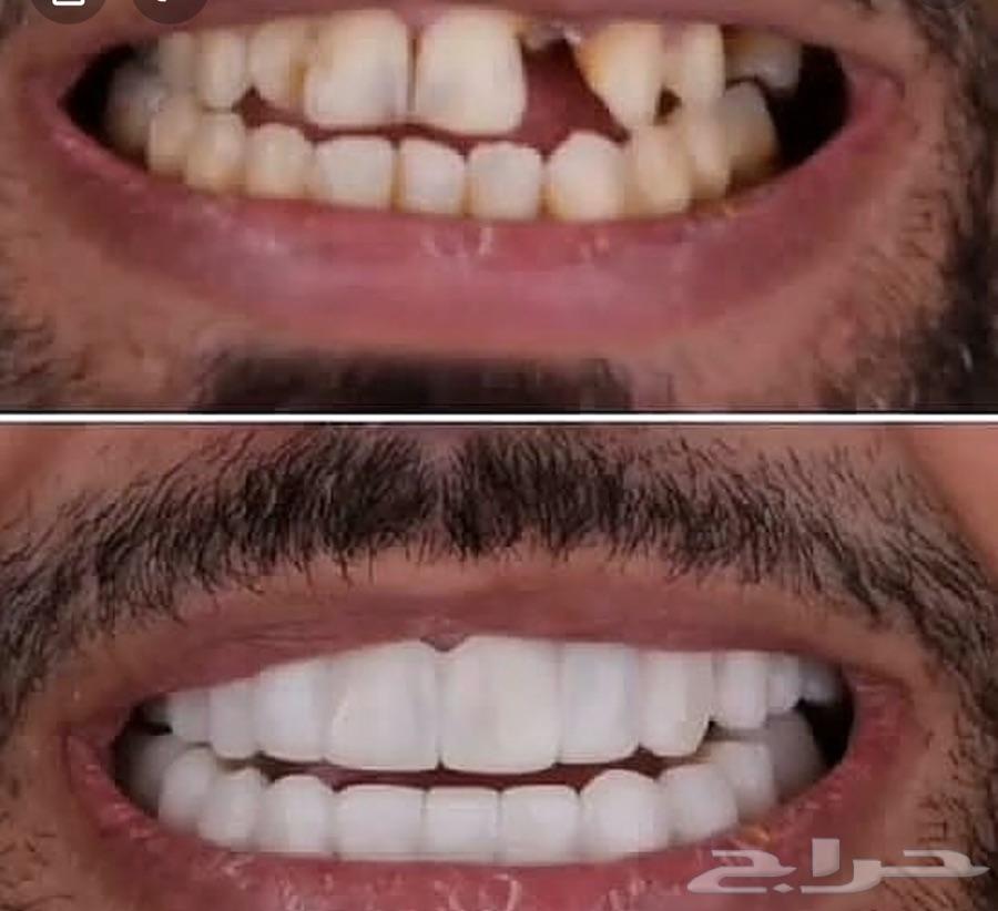 ابتسامه هوليود متحركه 1300