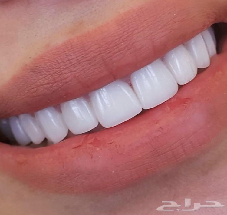 ابتسامة هوليود الثابتة